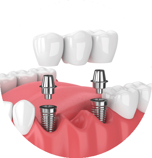 Dental Implant Bridge On 2 Implants