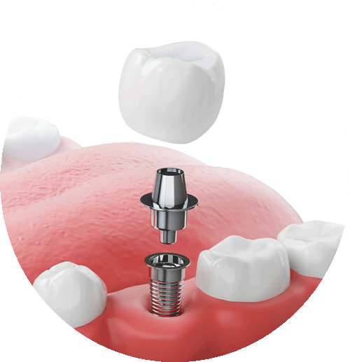 Single Dental Implant Post With Post, Abutment, & Crown